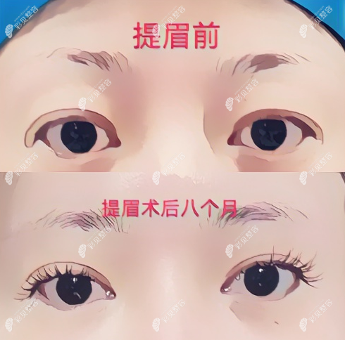 乌鲁木齐做提眉手术对比图