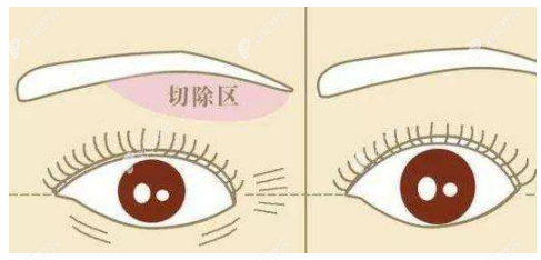 乌鲁木齐做提眉手术哪家医院好