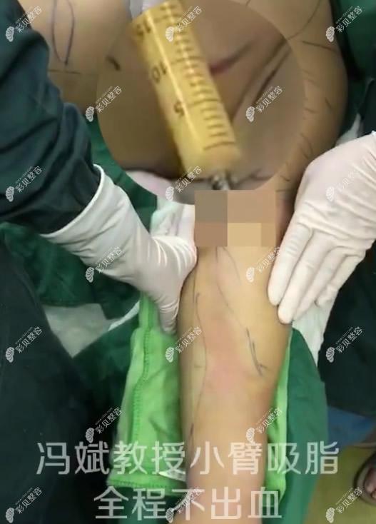 冯斌医生手臂吸脂全程不出血