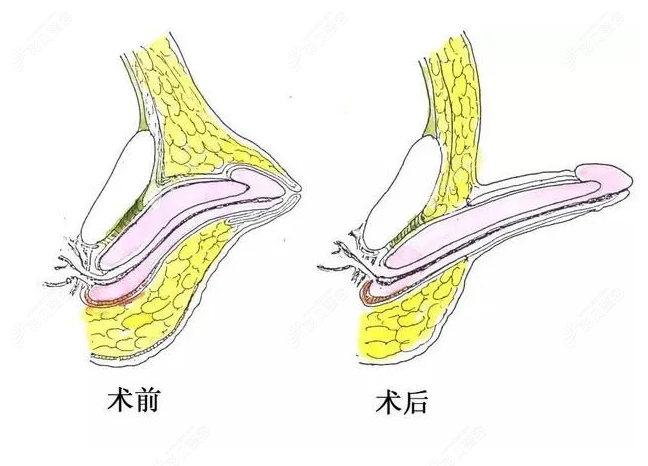 阴茎延长术价格一览看男性做阴茎增长手术一般要多少钱