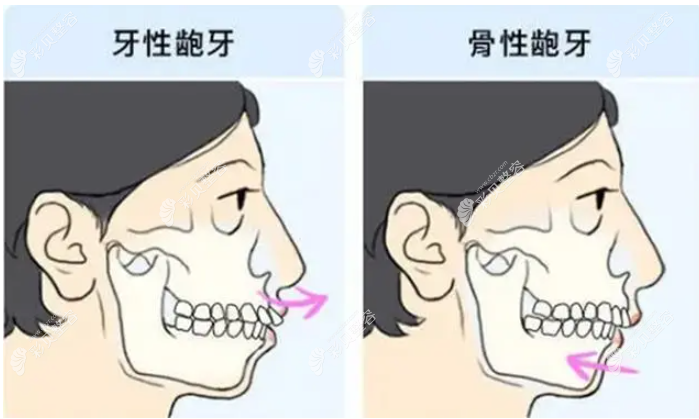 牙性龅牙和骨性龅牙