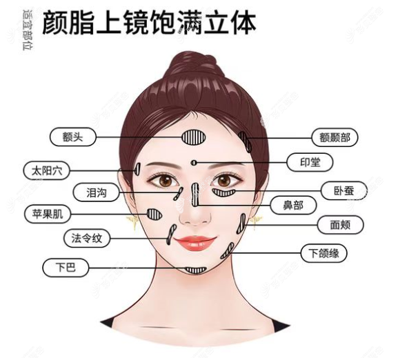 脂肪可以填充的面部部位