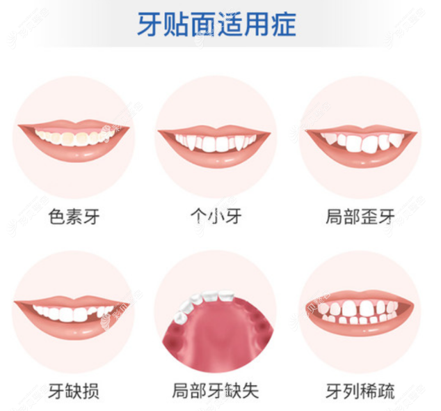 佛山登特口腔做牙贴面多少钱