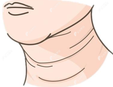 颈纹形成的原因有哪些？颈纹的去除方法有哪些？