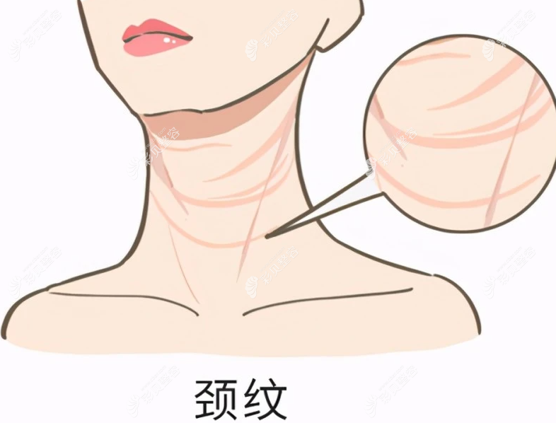 医美去颈纹可以维持多久?颈部拉皮,激光和嗨体去颈纹区别大