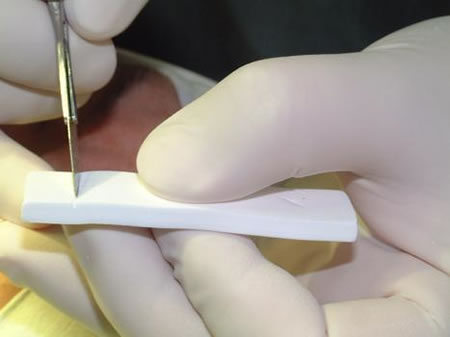 福州台江海峡美容医院福州海峡整形PTFE(高泰克斯)