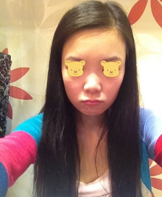 隆鼻详细过程分享 感受幸福的生活