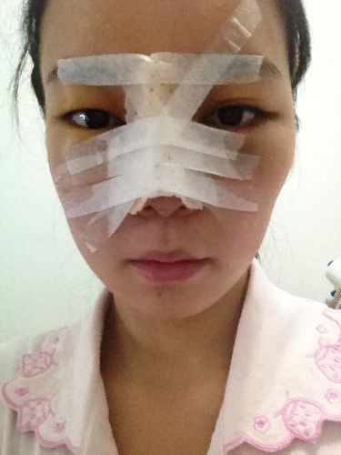 隆鼻详细过程分享 感受幸福的生活