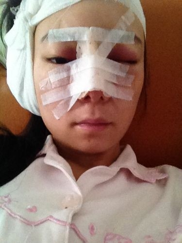 隆鼻详细过程分享 感受幸福的生活