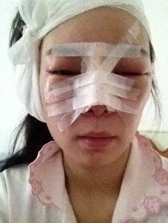 隆鼻详细过程分享 感受幸福的生活