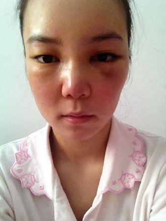 隆鼻详细过程分享 感受幸福的生活