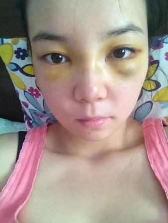 隆鼻详细过程分享 感受幸福的生活