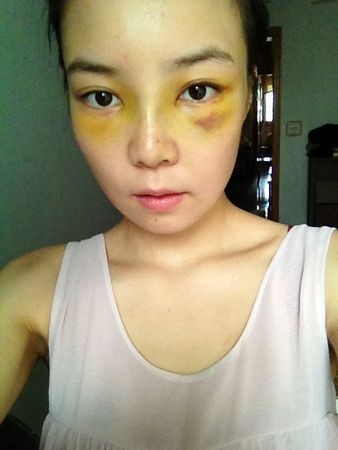 隆鼻详细过程分享 感受幸福的生活