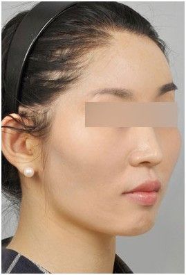 真实日记：我的颧骨整形经历