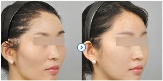 真实日记：我的颧骨整形经历