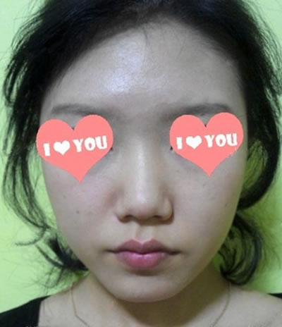 小女子隆鼻一个月^-^附术后详细照片^-^从丑鬼到美女的转变…
