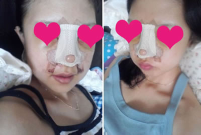 这个是第三天的，肿得特别厉害，听医生的话、忌食。脸上的淤青变得黄黄的，痛苦啦。