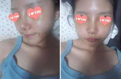 鼻子好很多了，轮廓也大概出来了。淤青变淡了好多，期待快点恢复。