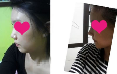 高度和鼻尖做出来了，感觉整个人精神不少！ 一个人较重要的就是立体感了，我非常满意现在的样子！