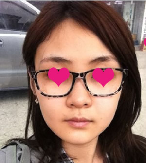 面部还有一些小浮肿。但朋友们都说我的面部线条变温和了很多!我听到这话的时候感觉非常开心，原来我还真的有这样变美的一天啊!