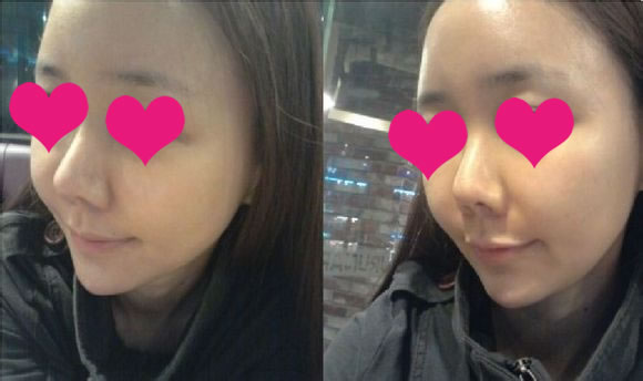 终于揭掉了下巴处的胶布，我现在可以正常的洗漱了呢，我非常开心!

现在本应是术后浮肿得较厉害的时刻，但我的脸肿得不是很厉害呢，可能是我的恢复速度比较快吧~~~~

