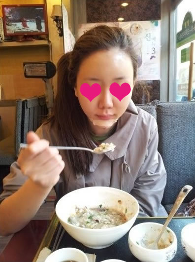 手术当天的时候我很紧张，可当我躺在手术台上之后，想着当我一觉醒来的时候，就会拥有饱满的童颜时，心里的紧张被满满的期待代替了，希望手术能顺利结束。

当我醒来之后，件事就是照镜子，当我看到镜子里的自己的时候我真的十分感动，好后悔自己怎么现在才决定做手术呢

