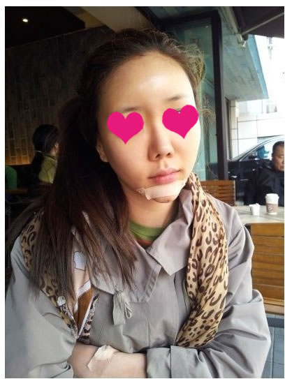 这是手术当天的照片，肿得不是很厉害吧?

在我做完手术之后，我就这个样子去吃饭，去喝茶去了呢。
