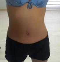 吸脂不等于减肥，我总算了解是啥意思了。本以为一做吸脂就直接变苗条~ 但不是，体重也没想象的那样有翻天覆地的变化。 但是可以让我的身体线条更加明显。
刚做完吸脂后一周较难熬，因为肿没有完全消除，坐着仍很难过。