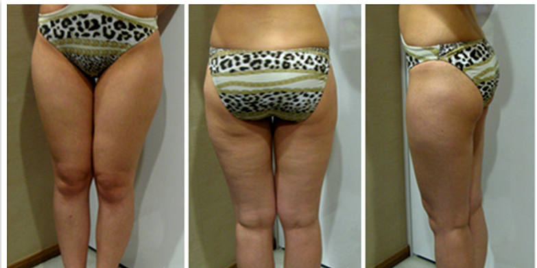 为了一生一次的婚姻，我拼上吸脂瘦腿经历~~~~