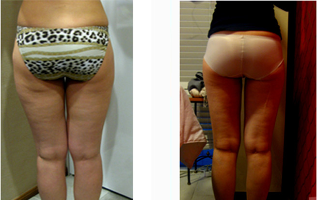 根据每个人体质的不同，淤青也是不一样的，有的人在术后有很多淤青，有的人在术后可能没有任何淤青呢。
不久我就要结婚了，我原本很担心来着，但现在不需要有任何烦恼，我可以穿着漂亮的婚纱，去度蜜月了，恭喜我吧!