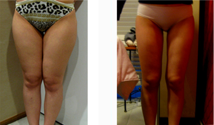 为了一生一次的婚姻，我拼上吸脂瘦腿经历~~~~