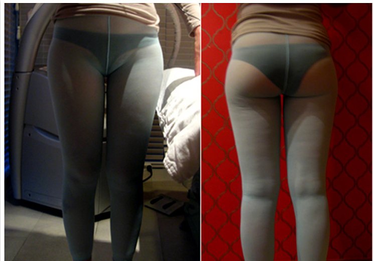 为了一生一次的婚姻，我拼上吸脂瘦腿经历~~~~