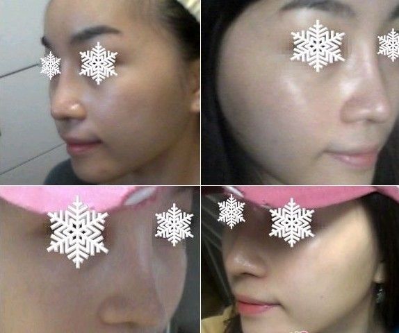 手术后一个月~~各个角度都有哦~