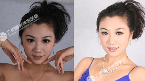 吴雅光子嫩肤对比图