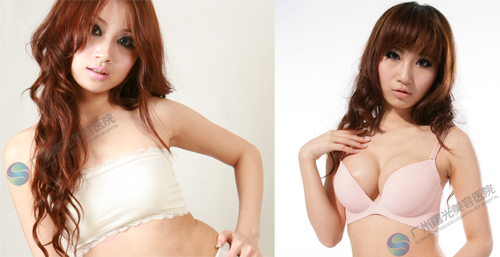 瑶瑶术前、术后对比图