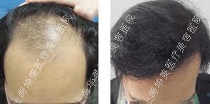 毛发移植手术案例对比图