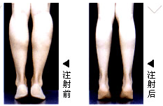 微创瘦小腿手术