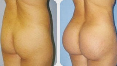 臀部水动力环形吸脂翘臀案例