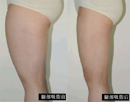 瘦腿成功案例 