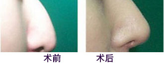 北京清木鼻翼整形前后对比图