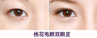 北京清木桃花电眼双眼皮手术前后对比