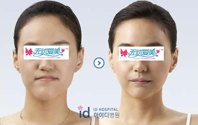 面部反颌整形手术对比案例图