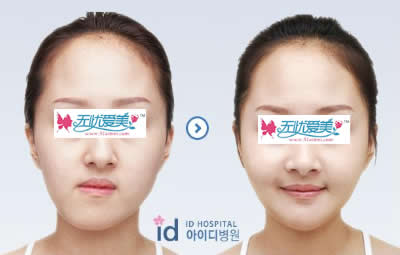 面部双鄂整形手术对比案例图