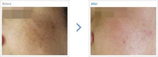 [高兰得整形外科]激光治疗—弹性和皱纹 前后照片