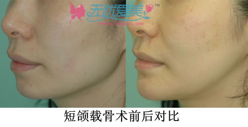 短颌载骨术