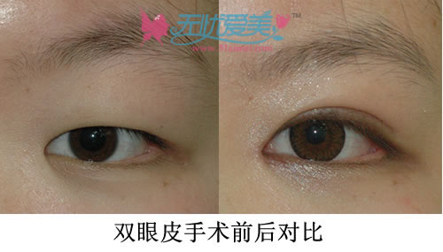 双眼皮手术对比案例