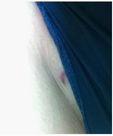 吸脂瘦腿终于让我瘦下来了，大象腿真心伤不起……