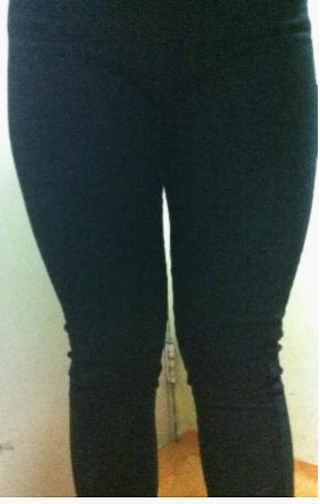 吸脂瘦腿终于让我瘦下来了，大象腿真心伤不起……