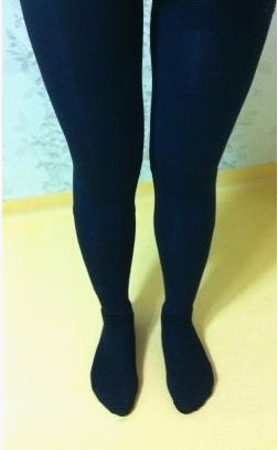 吸脂瘦腿终于让我瘦下来了，大象腿真心伤不起……