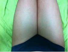 吸脂瘦腿终于让我瘦下来了，大象腿真心伤不起……